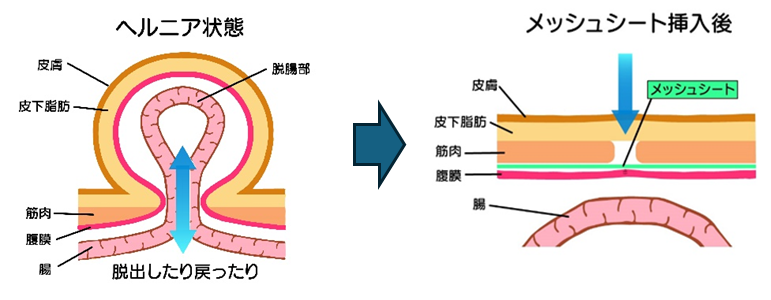 鼠径部４